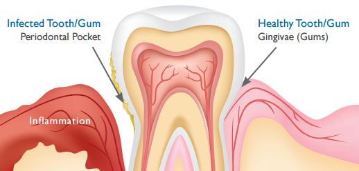Healthy & Infected Gums Image